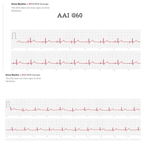 Apple Watch 4 EKG Technology - Nurse Katie