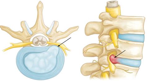 Pinched Nerves Don’t Have To Be A ”Pain In Your Neck”! – Physio Performance