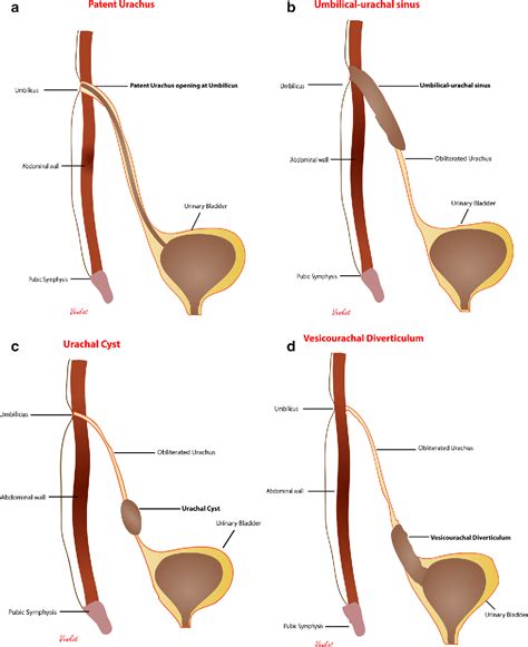 Imaging of urachal anomalies | Semantic Scholar