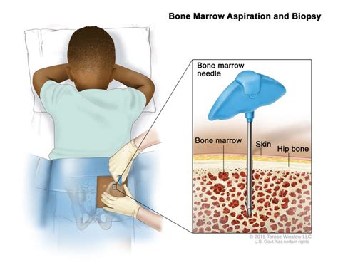 Neuroblastoma Treatment - NCI