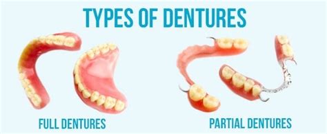 Dentures - Accent Dental Group