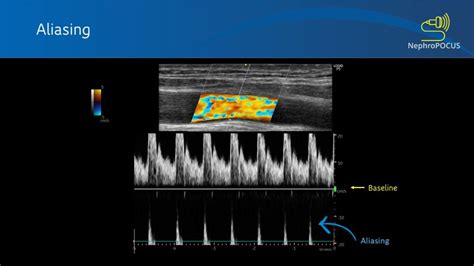 Basics of Doppler Ultrasound for the Nephrologist- Part 2 - Renal ...