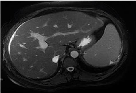 MRI of liver showing peri-portal fibrosis, portal hypertension,... | Download Scientific Diagram