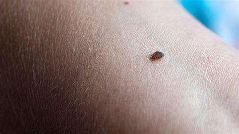 Bed bug bites: Pictures, treatment, and prevention