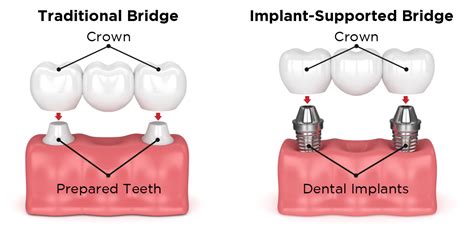Traditional Dental Bridges & Other Types of Dental Bridges in Sparta, NC