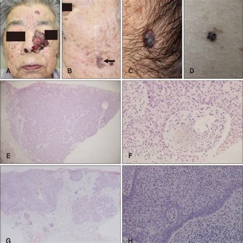 Nodular BCC presents as well-defined translucent pearly nodule that is ...