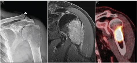 Figure 1 from Diagnosis of bone metastasis from thyroid carcinoma: a multidisciplinary approach ...