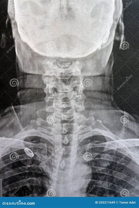 Plain X Ray Cervical Vertebrae Showing Straightening of Cervical ...