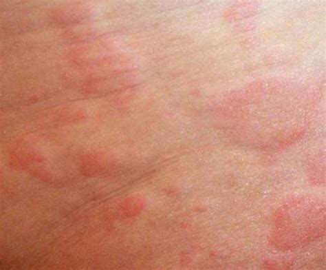 Itchy Skin Rash - Pictures, Causes, Symptoms, Treatment
