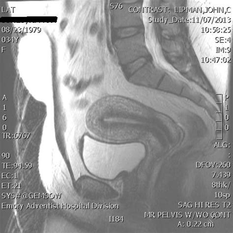 Pelvic MRI for Fibroids - Why You Need an MRI to Detect Fibroids