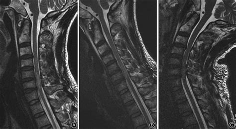 Cervical kinematic MRI of spinal cord injury in a 44-year-old male ...