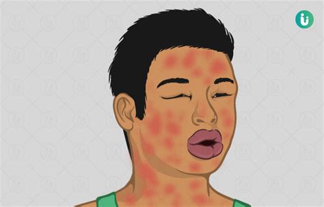 Anaphylactic Shock: symptoms, causes, treatment, medicine, prevention, diagnosis