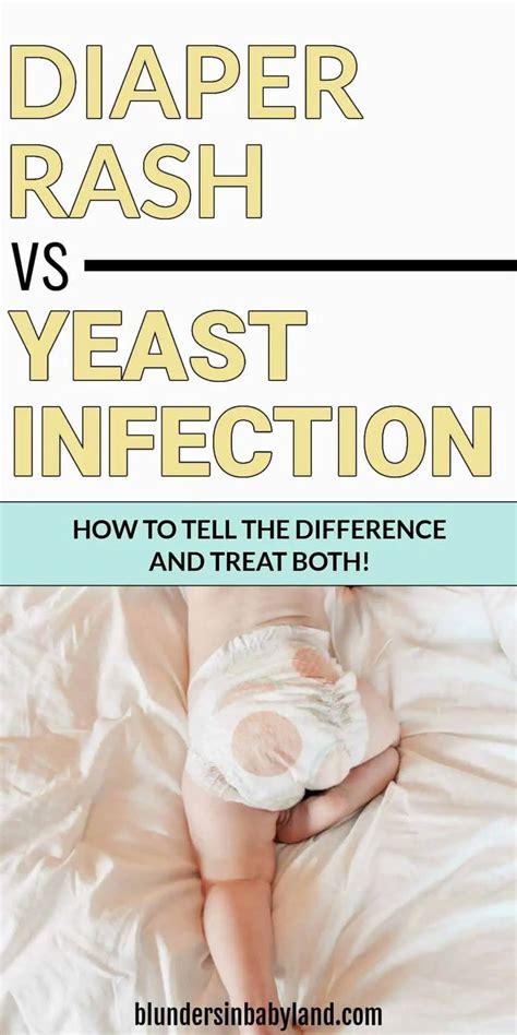 Diaper Rash vs Yeast Infection: How to Tell the Difference & Treat Both | Diaper rash, Diaper ...