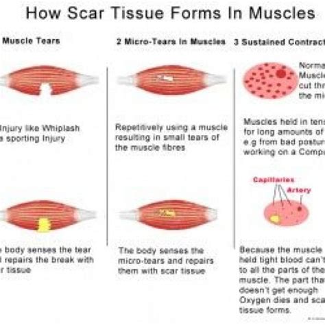 The three ways that muscles can acquire scar tissue. Muscle Tears Micro-Tears in Muscles and ...