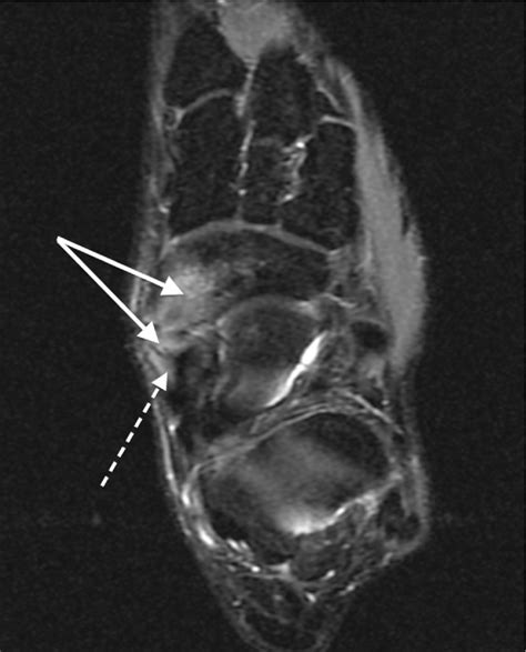 Figure 8 from Clinical and radiological findings (radiography, CT scan and MRI) in patients with ...