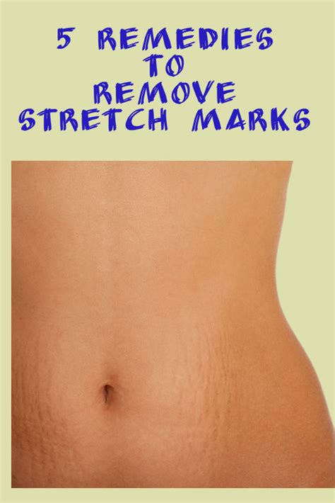 5 remedies to remove Stretch Marks