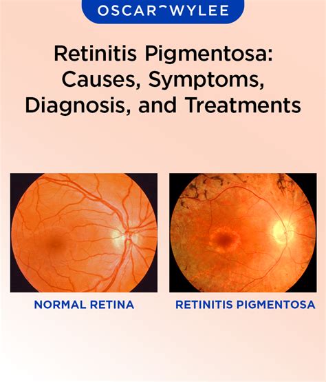 Retinitis Pigmentosa: Causes, Symptoms, Diagnosis, and Treatments