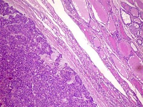 Thyroid Adenoma Histology