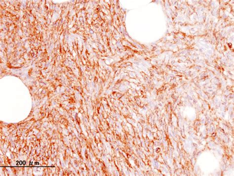 Dermatofibrosarcoma protuberans - wikidoc