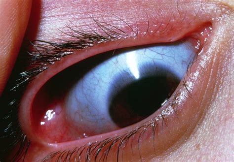 Blue Sclera Of Eye In Osteogenesis Imperfecta Photograph by James ...