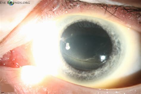 Whorl Keratopathy