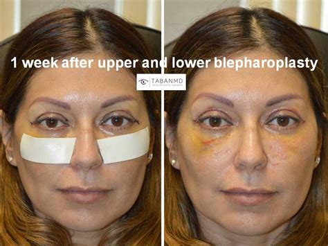 Upper Blepharoplasty Beverly Hills | Eyelid Lift Los Angeles