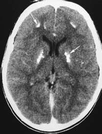 119 Pseudohypoparathyroidism | Radiology Key