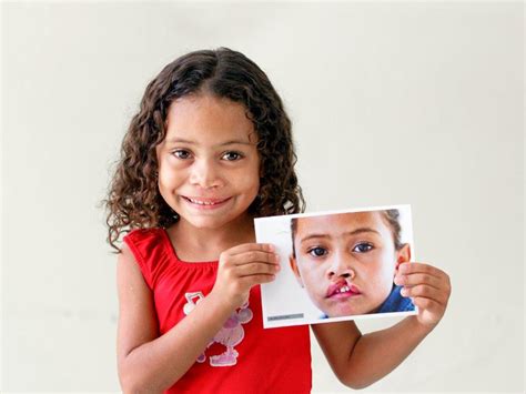 Case Study: Operation Smile & Avante - Avante Outreach