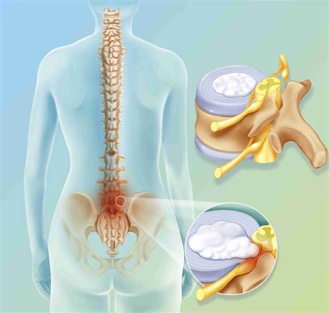 Warning Signs: You May Have a Lumbar Herniated Disc - Web bloggers