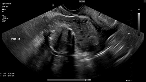 Gynaecology Ultrasound - Women's Ultrasound Melbourne