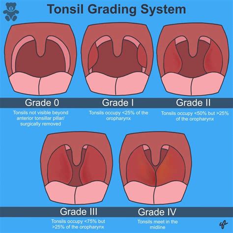 Tonsillitis - Clinical Features - Management - TeachMePaediatrics