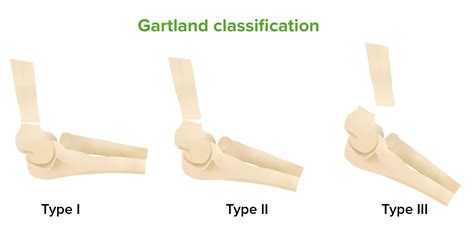 Fratura Supracondiliana | Concise Medical Knowledge