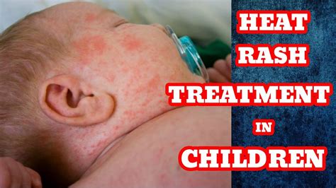 Heat Rash Treatment | How to Get Rid of Heat Rash In Babies, Home ...