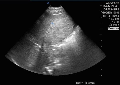 Hennepin Ultrasound | What’s causing his RUQ pain?