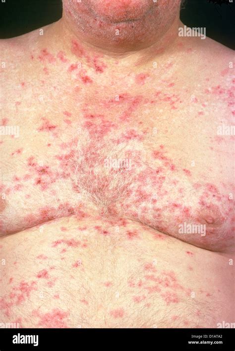 La dermatitis herpetiforme Fotografía de stock - Alamy