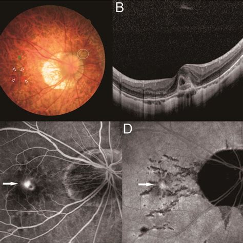 Choroidal thickness (CT) was measured at 14 locations in macular area... | Download Scientific ...