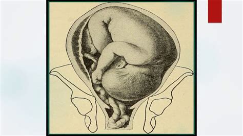 Pin on evidence-based advice on the prevention, diagnosis and management of umbilical cord prolapse