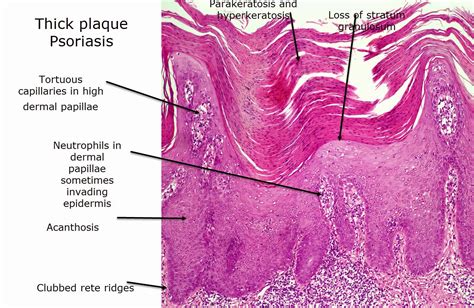 Dermatopathology Made Simple - Inflammatory: Psoriasiform Reaction Pattern