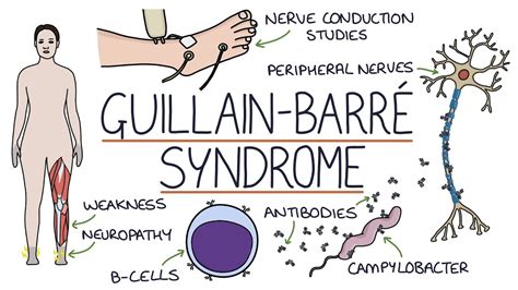 Understanding Guillain-Barré Syndrome - YouTube