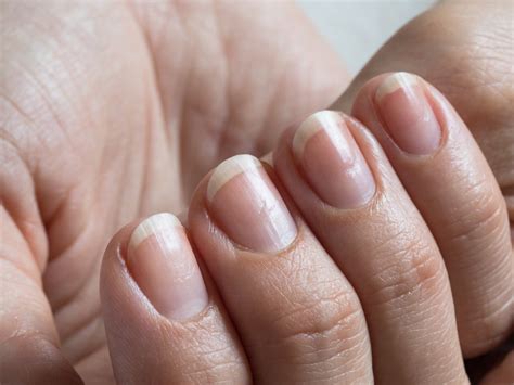 Onycholysis - A Condition Where Nails Separate From The Nail Bed ...