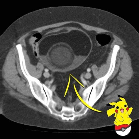 Radiology Signs • Ovarian mature cystic teratoma (dermoid cyst) on...