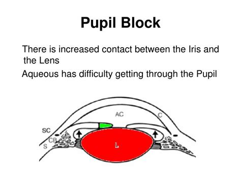 PPT - ACUTE ANGLE CLOSURE GLAUCOMA PowerPoint Presentation - ID:671613