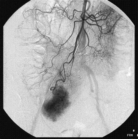 Selective superior mesenteric artery angiogram showing | Open-i