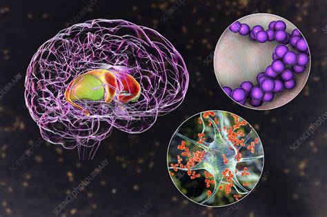 Sydenham's chorea, illustration - Stock Image - F033/5824 - Science ...