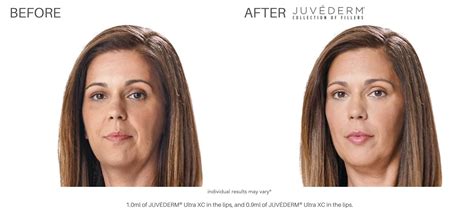 Juvéderm Before and After | Real Patient Results Newport News, VA