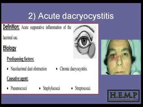 2 acute & chronic dacryocystitis - YouTube