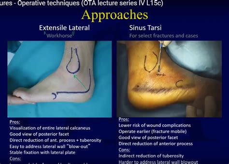 Surgical treatment of Calcaneal fractures — OrthopaedicPrinciples.com