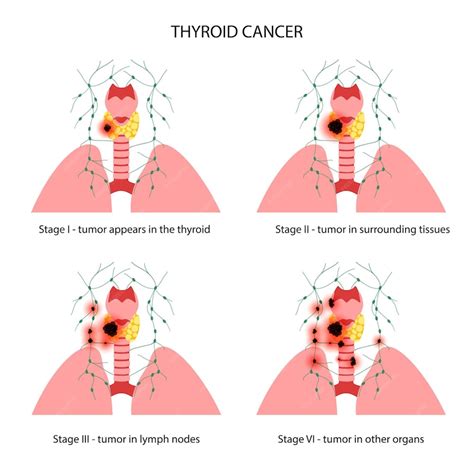 Premium Vector | Thyroid cancer stages