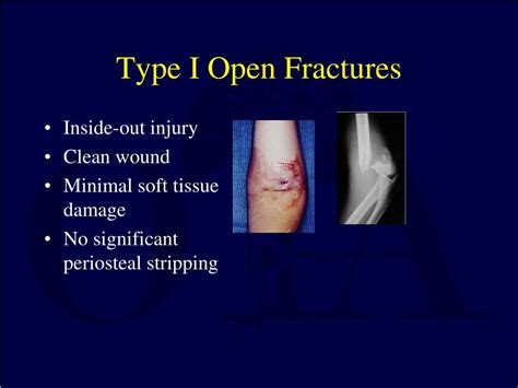 PPT - Fracture Classification PowerPoint Presentation, free download - ID:3349217