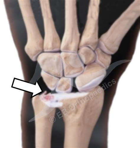 Tfcc Tear Surgery - Triangular Fibrocartilage Complex (TFCC) Injury ...